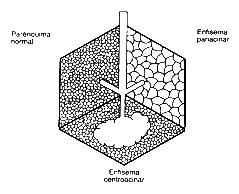 Tipos de enfisema